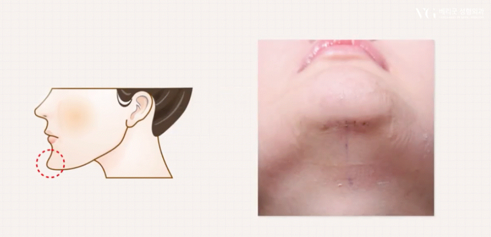 강남역 마녀턱 턱끝거상 , 리프팅원인 수술방법 총정리 관련 이미지 14