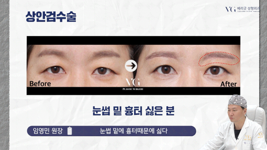 강남중년눈성형 잘하는곳 , 상안검 하안검 눈썹하거상술종류 진행방법 궁금하다면 관련 이미지 34