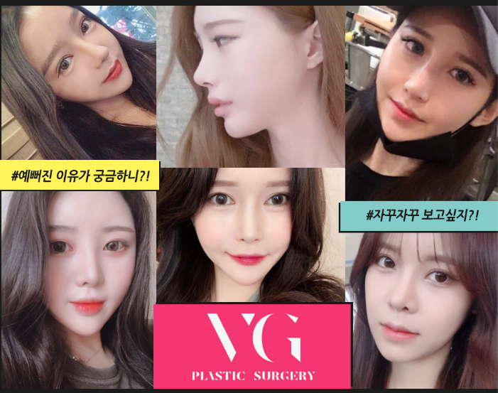 엑설런트코성형으로 콧대높은 자신감 얻자! 관련 이미지 14