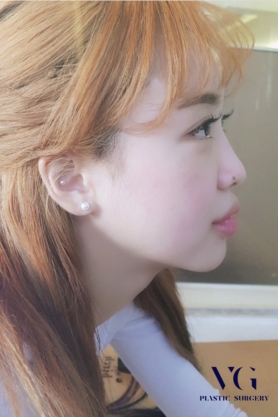 코재수술전후 확실하게 확인하고 성공적으로 관련 이미지 1