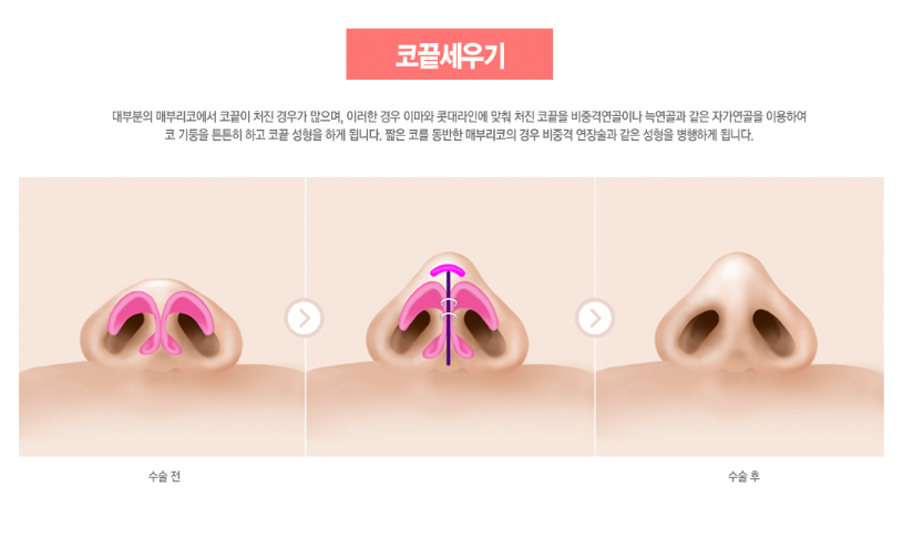 매부리코, 코성형 유형에 맞게 수술하자 관련 이미지 7