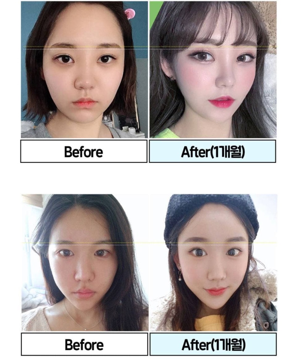이마거상술 잘하는곳,이마거상술 가격 알아보자 관련 이미지 6