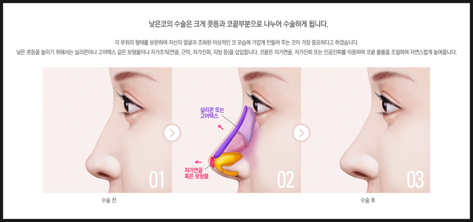 코성형 얼굴전체적인 비율에 맞춰 관련 이미지 2
