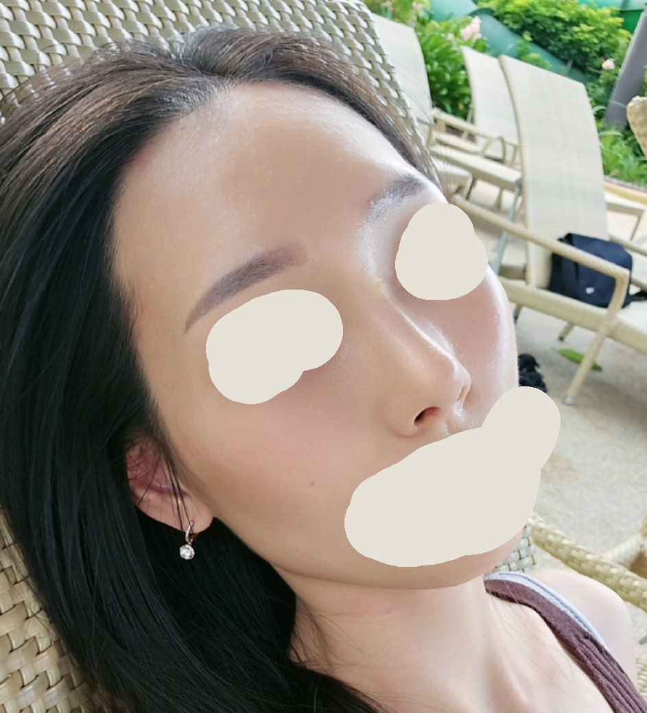 첫코수술 코끝수술 비중격교정술 하비갑개절제술 베리굿성형외과 전후후기 관련 이미지 3