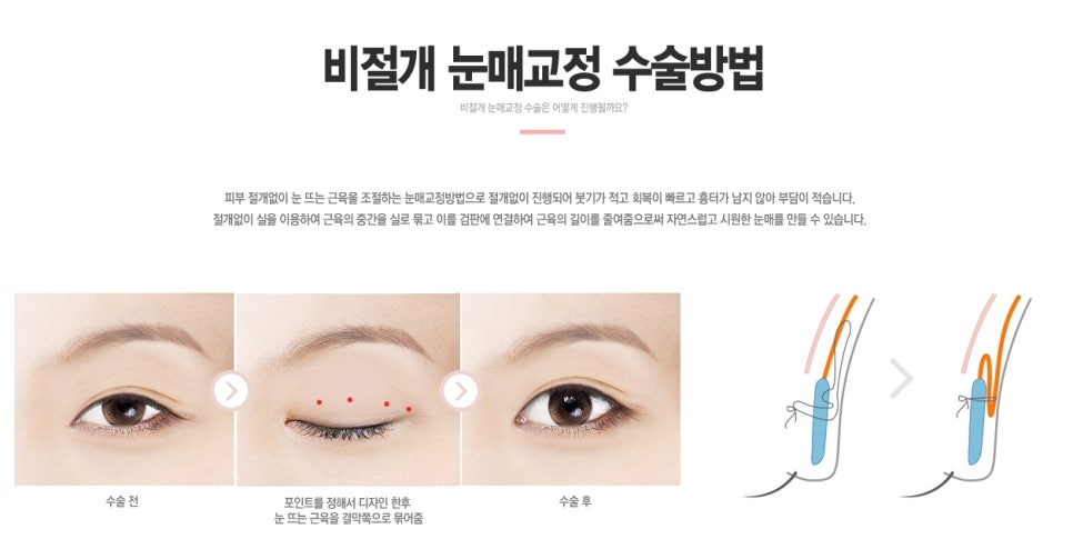 [베리굿성형외과 강남눈매교정]누구나 반하는 또렷한 눈매만들기✨ 관련 이미지 4