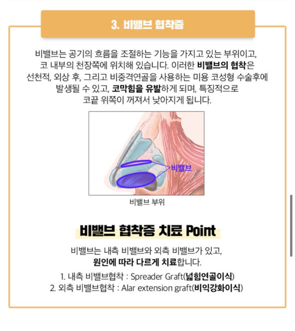 베리굿 비염코성형✨비염수술과 코성형을 동시에? 관련 이미지 6