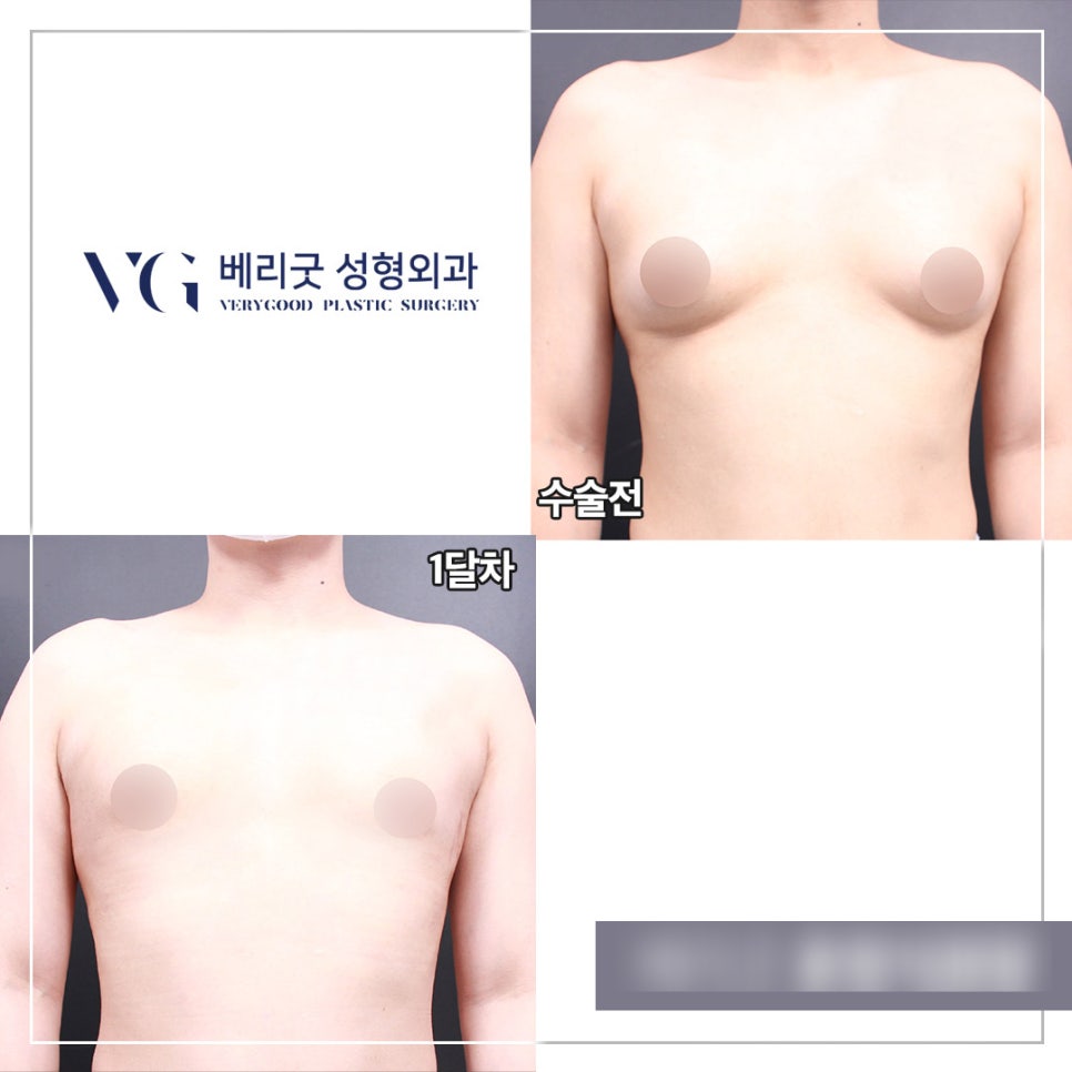 남자여유증수술 베리굿성형외과👨&zwj;⚕️ 관련 이미지 9