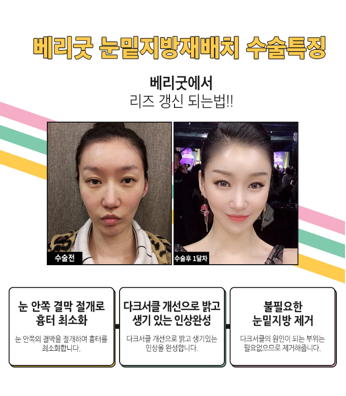 눈밑지방재배치수술로 팬더탈출! 재발없는 수술하는법? 관련 이미지 5