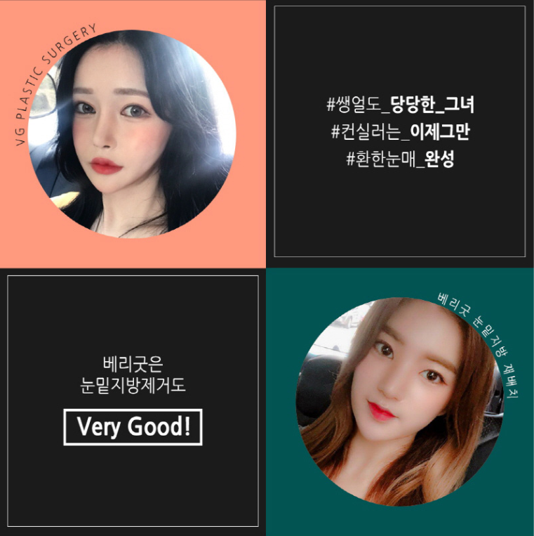 눈밑지방재배치후기 밝고 환해진 인상 관련 이미지 1