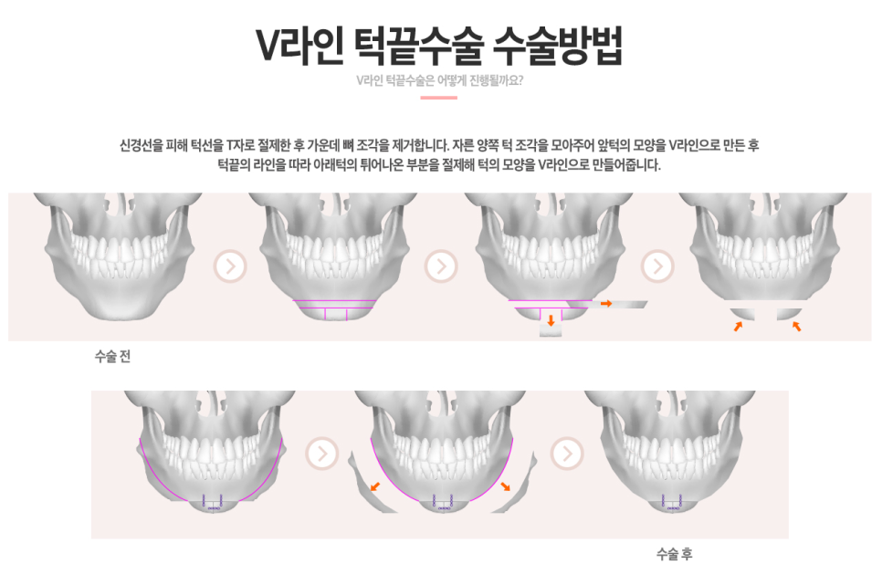 베리굿&hearts;얼굴에 찰떡! 베리굿 V라인 턱끝축소 관련 이미지 3