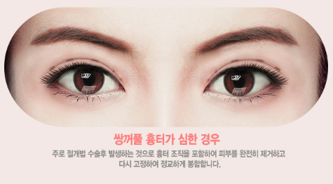 눈재수술, 원인과 상태에 따라 방법도 바뀐다? 관련 이미지 6