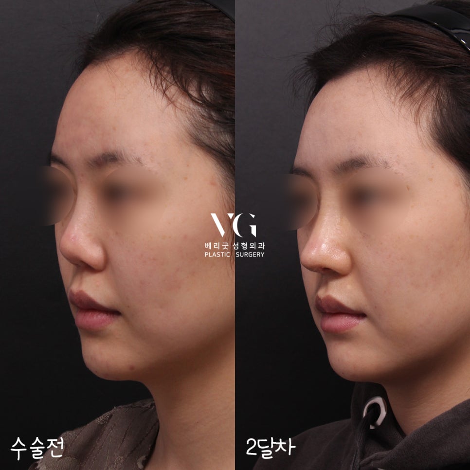 짧은 첫코성형도! 구축된 코재수술도! 베리굿성형외과✨ 관련 이미지 1