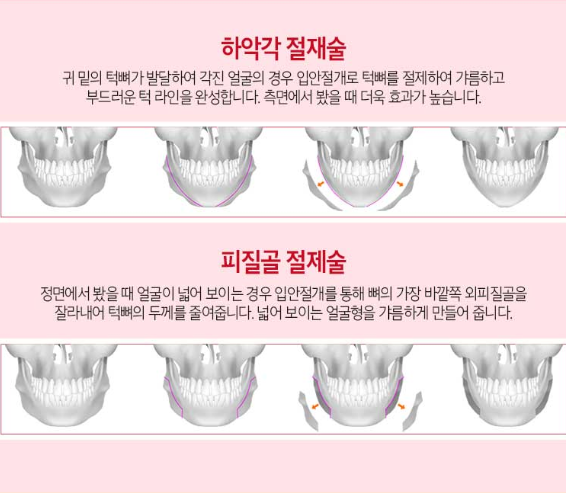 안면윤곽의 모든것이 알고싶다면!! 관련 이미지 7