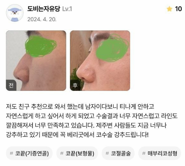 Primary Rhinoplasty, Tip Surgery, Osteotomy, Hump Correction, Donor Rib Cartilage | 베리굿성형외과 Before-and-After Review image 3