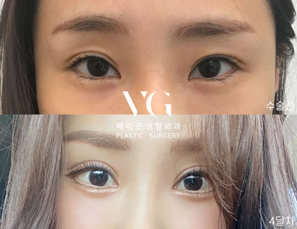 마지막은 쌍수는 베리굿에서 블링블링하게 베리굿 눈재수술전후👀✨ 관련 이미지 4