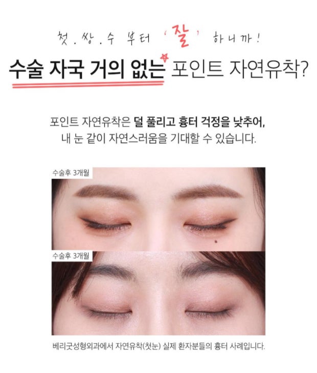 매몰은 걱정되고 절개는 부담될 때, 강남역 자연유착병원 첫 쌍수 추천 관련 이미지 4
