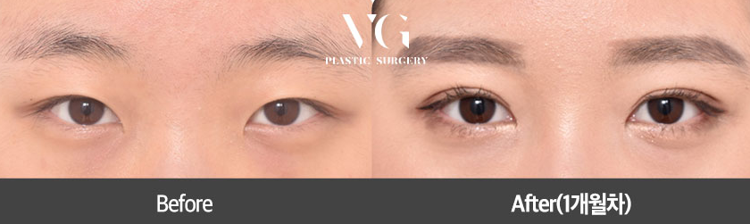 아름다움을 위한 시작, 베리굿성형외과 눈 성형(자연유착) 관련 이미지 8