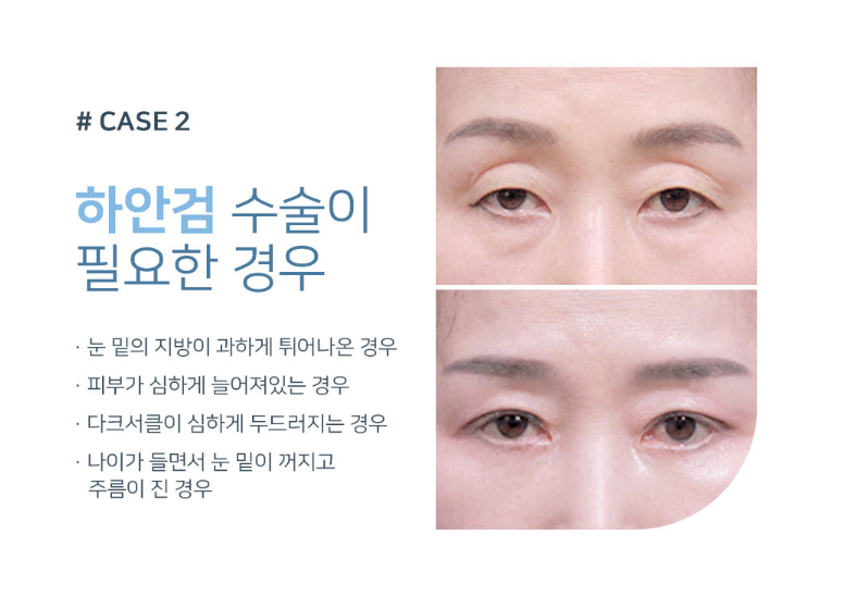 처진 눈꺼풀로 답답한 인상, 강남역 중년 눈성형으로 교정하기 관련 이미지 3