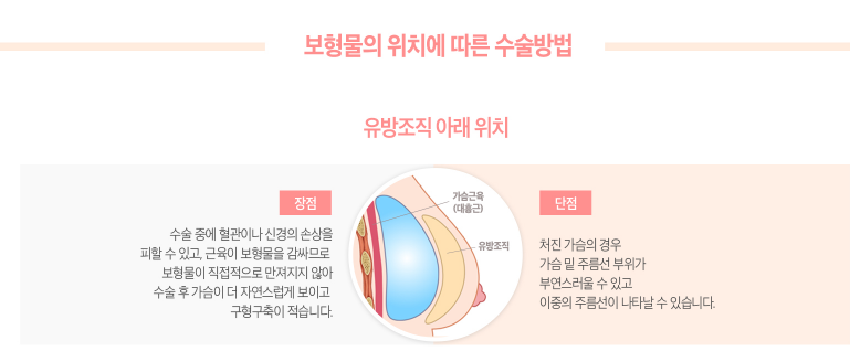 가슴성형 아름다운 라인을 위해 꼼꼼히 알아보자! 관련 이미지 8