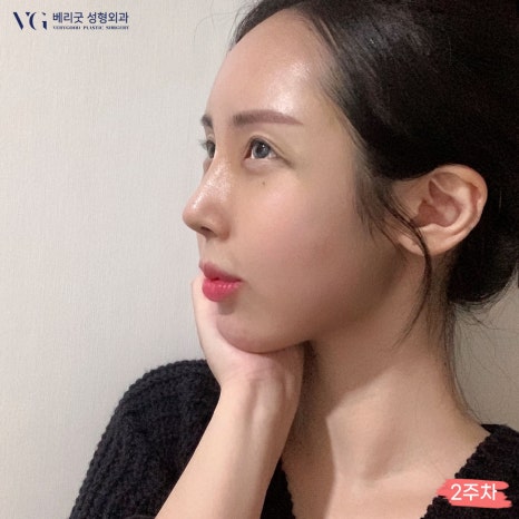 베리굿성형외과 기증늑연골 짧은코교정💖 관련 이미지 2
