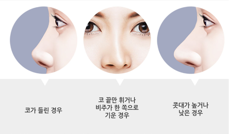 베리굿성형외과 엑설런트 코재수술 이벤트! 내생에 마지막 코수술! 관련 이미지 6