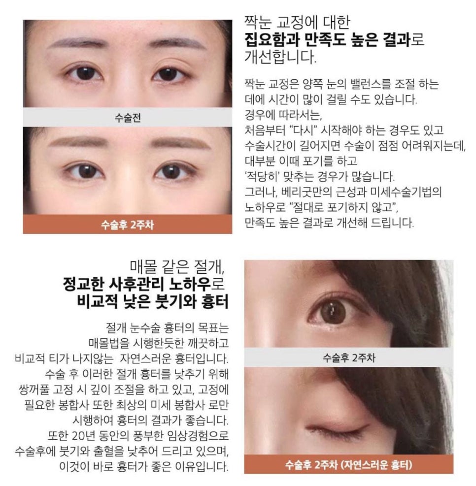 눈재수술잘하는곳, 눈재수술가격 관련 이미지 4