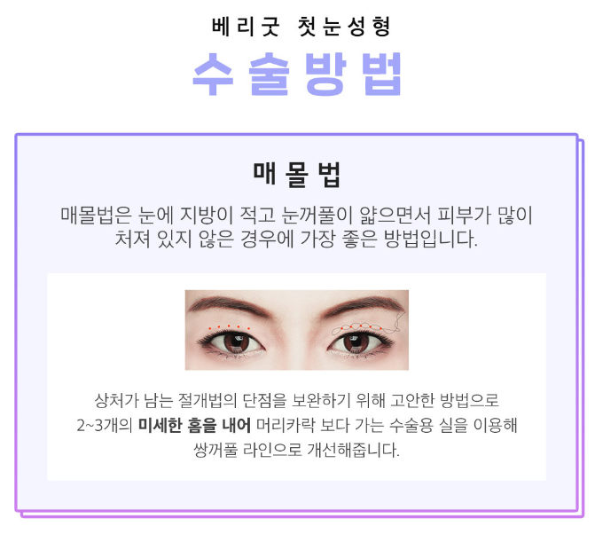 첫눈수술 절개?자연유착? 적합한 수술방법으로 관련 이미지 3