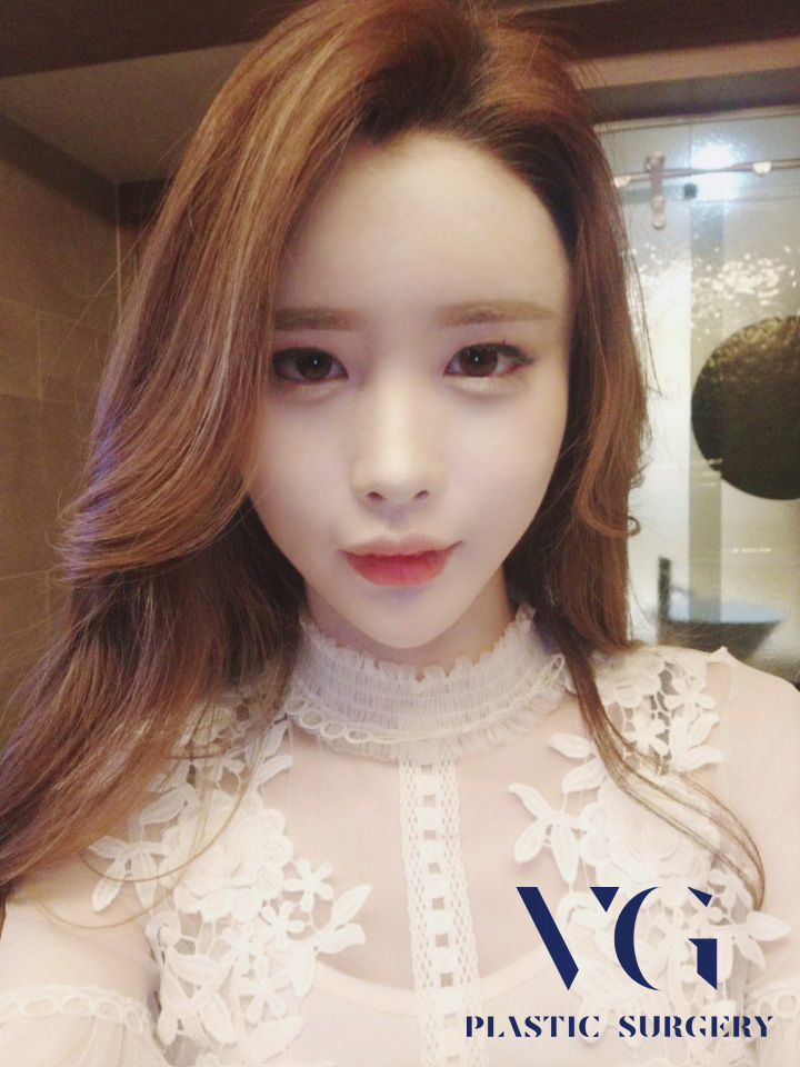 코성형 꼼꼼하게 알고 하자 관련 이미지 1