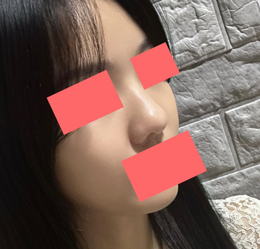 첫코수술 절골 기증늑연골 비중격교정술 하비갑개절제술 베리굿성형외과 코수술 후기 관련 이미지 1