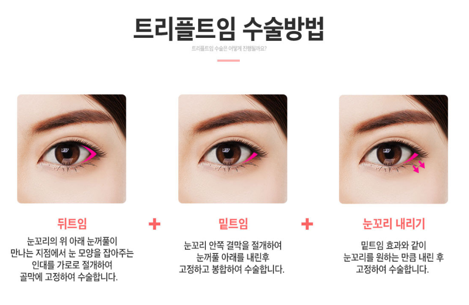 블링블링💖베리굿성형외과💖트임성형💖 관련 이미지 5