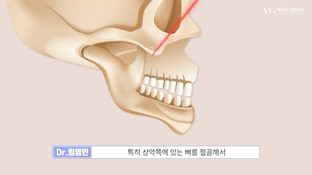 안전성형지향 강남성형외과 , 성형알아볼때 병원 선택법 ? 수혈가능한 병원으로 선택하세요 관련 이미지 11