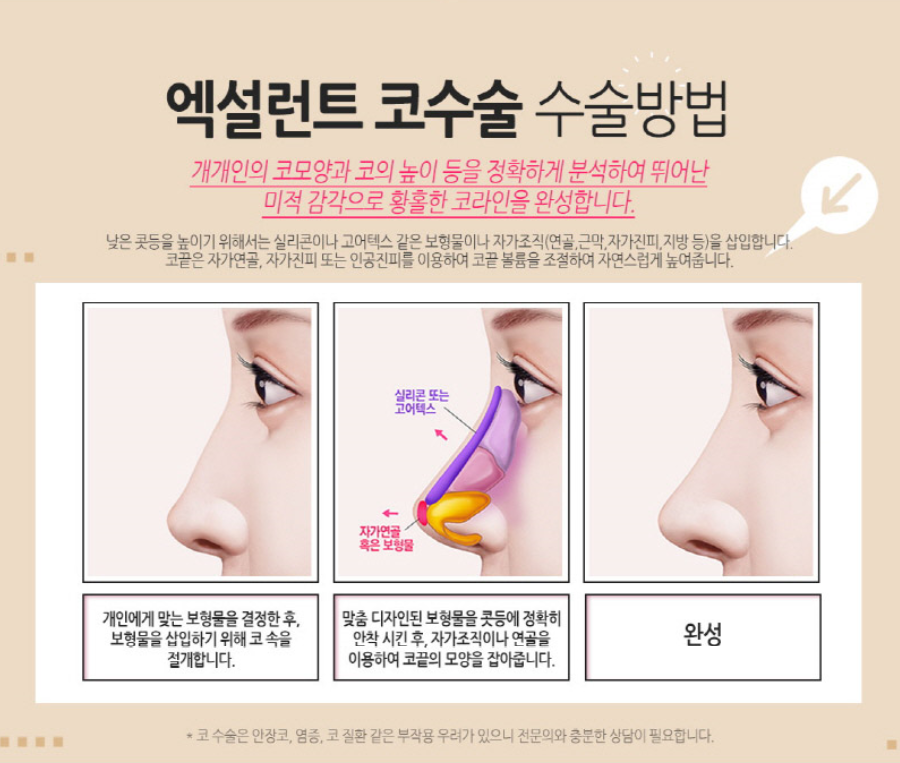 코성형 꼼꼼하게 알고 하자 관련 이미지 5