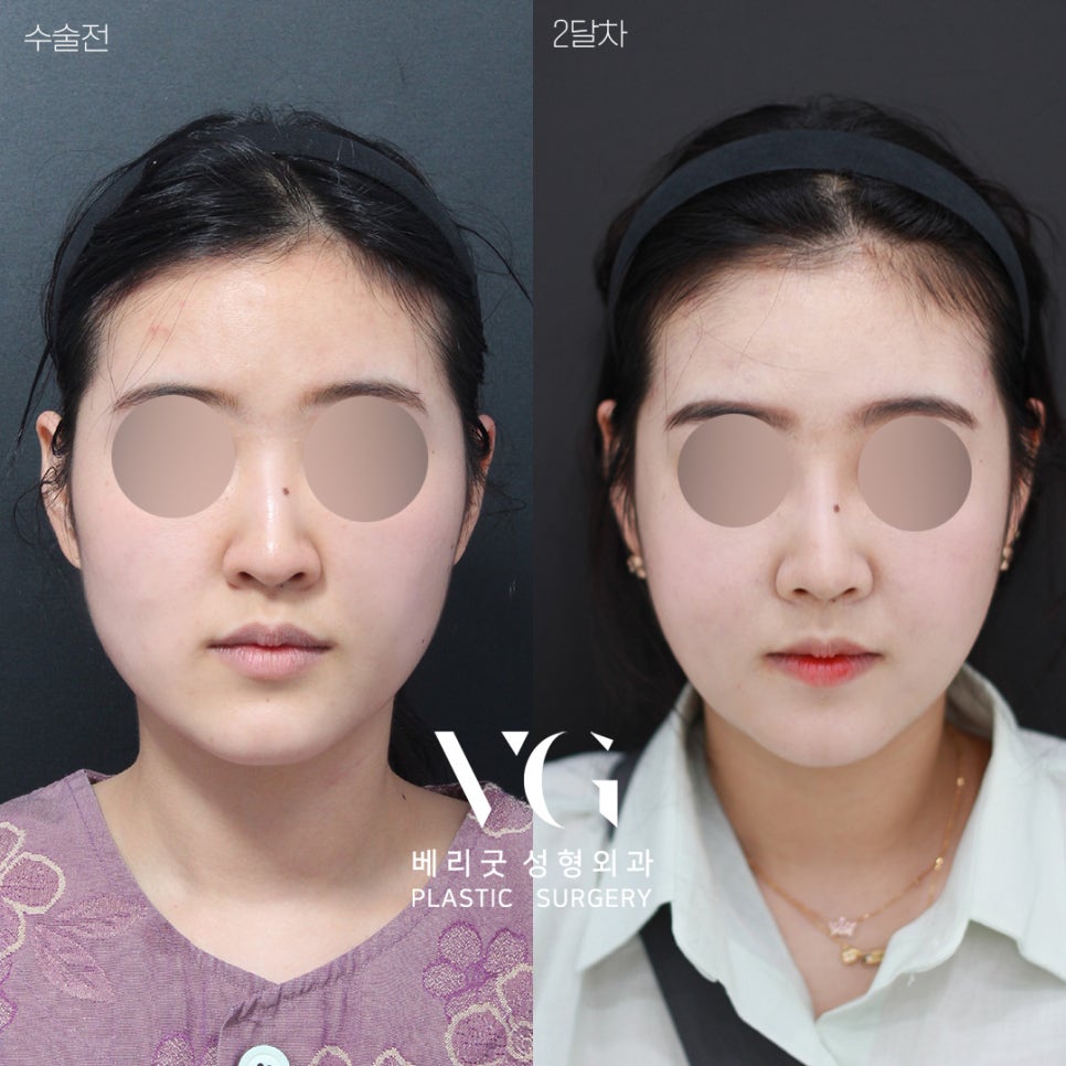 [베리굿성형외과]윤곽수술+코성형 REAL전후💖💖 관련 이미지 2