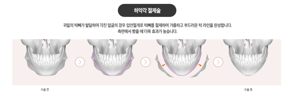 [ 베리굿성형외과 ] 안면윤곽 3종 Special한 REAL 전후비교 관련 이미지 4