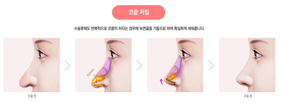 화려한 코라인, 베리굿성형외과 자가늑코성형✨ 관련 이미지 6