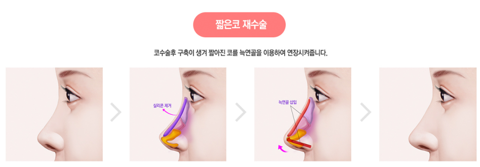 화려한 코라인, 베리굿성형외과 자가늑코성형✨ 관련 이미지 5