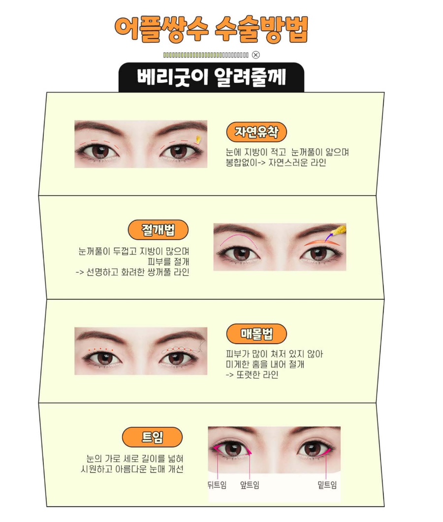 눈코수술후기 , 붓기 쌍수 코성형 회복기간 궁금하다면 관련 이미지 4