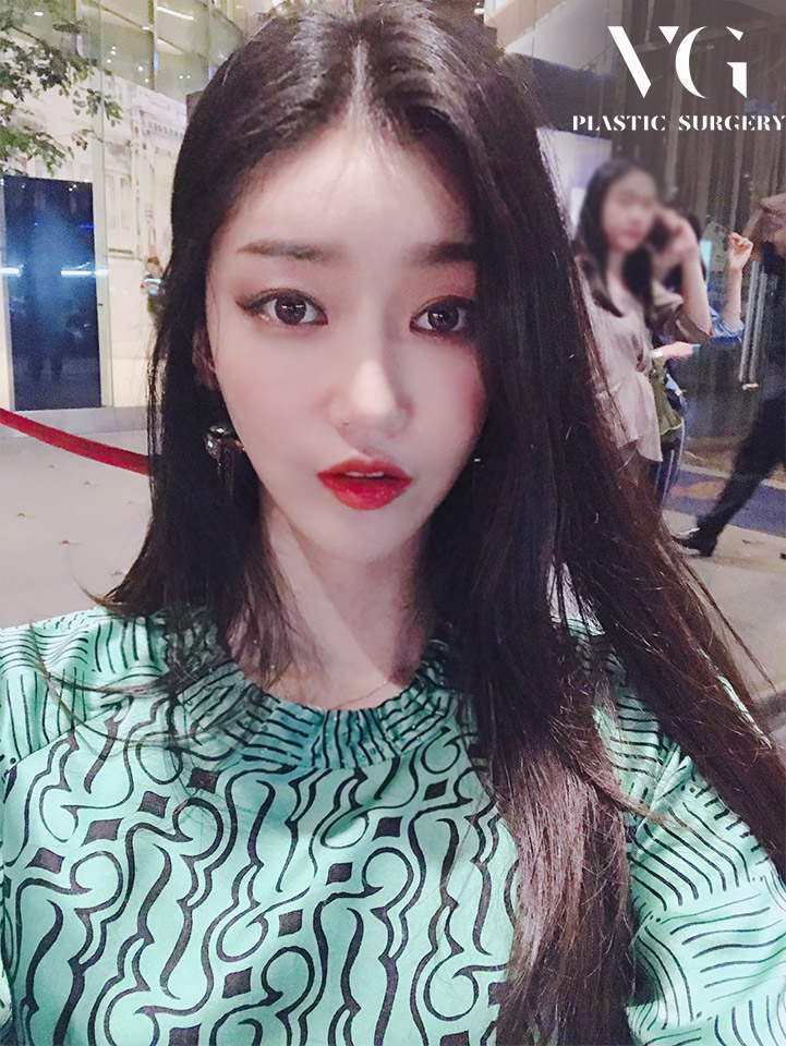 얼굴지방흡입 하고 포토샵이 필요없는 매끈한 얼굴라인 만들자! 관련 이미지 4