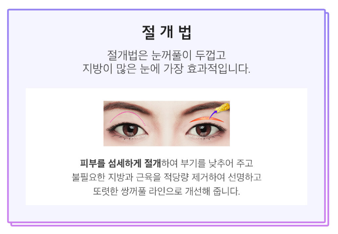 첫눈수술 절개?자연유착? 적합한 수술방법으로 관련 이미지 5