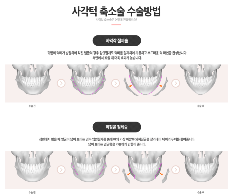 사각턱축소술 이젠 가리지말고 당당하게! 관련 이미지 3