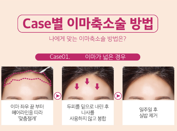 이마축소로 작고 아름다운 얼굴라인으로 변신! 관련 이미지 5