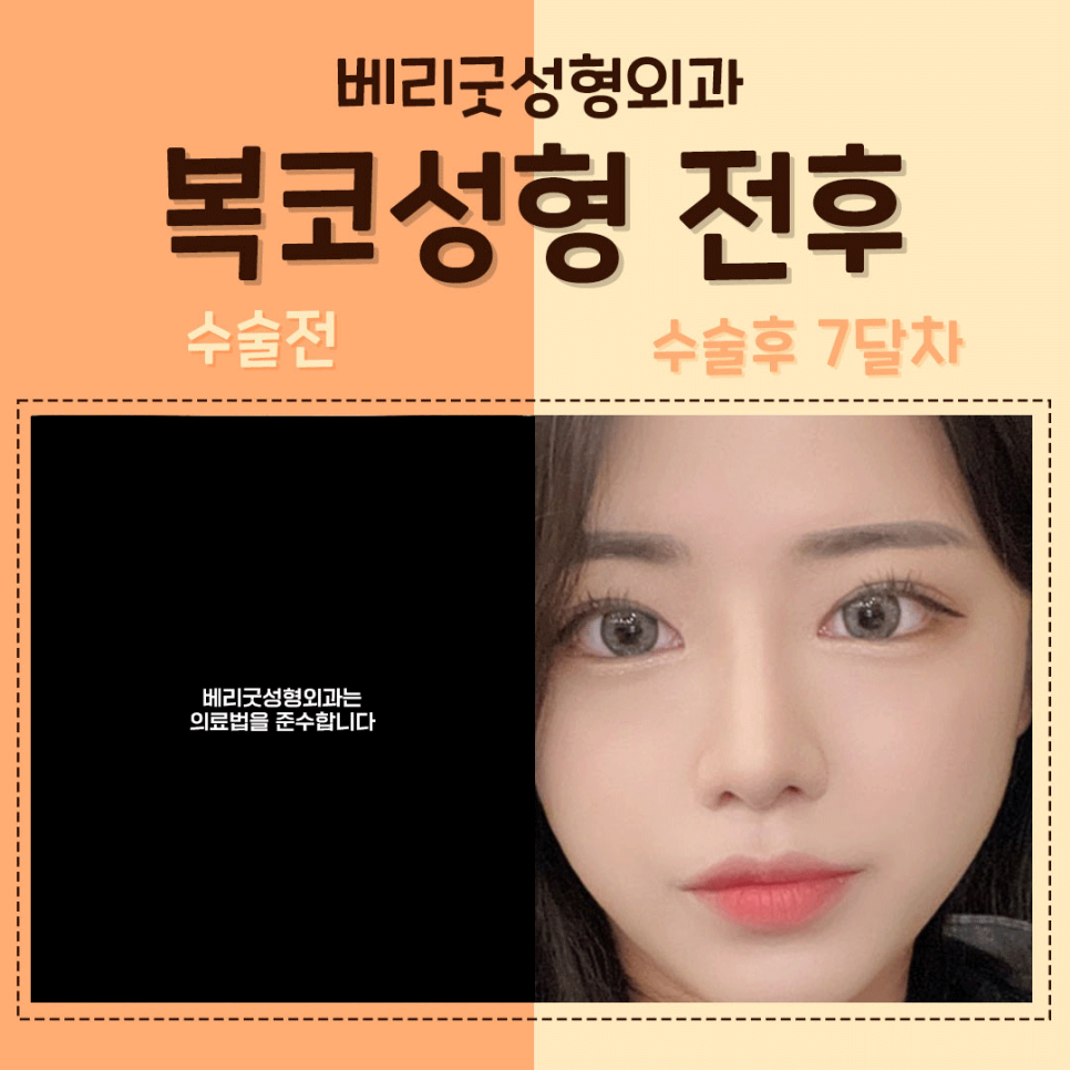 #복코성형 #복코수술 역시😘 #베리굿성형외과 관련 이미지 1