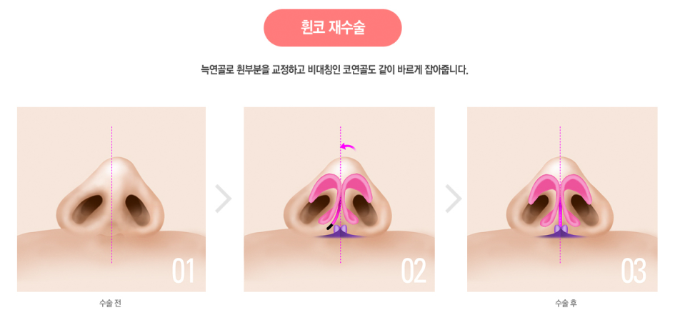 화려한 코라인, 베리굿성형외과 자가늑코성형✨ 관련 이미지 7