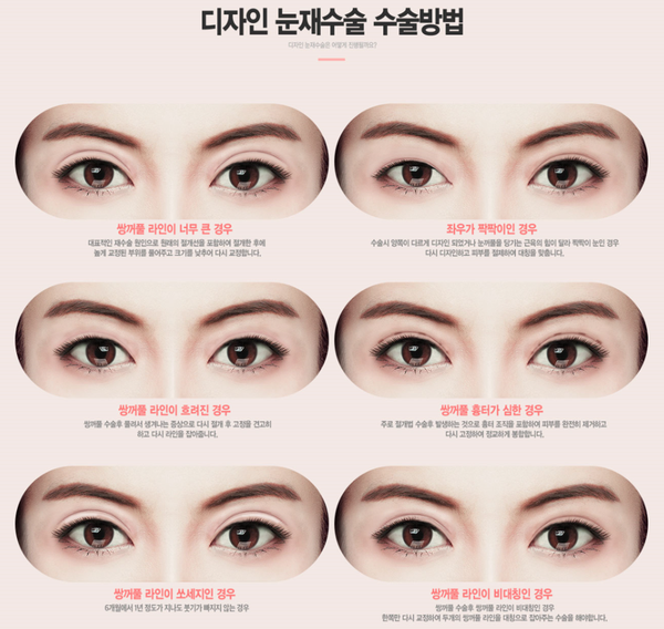눈재수술 원인을 정확히알고 하자! 관련 이미지 3