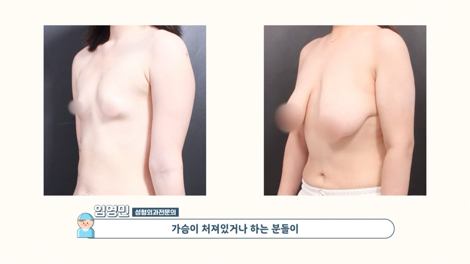 강남역가슴성형 절개법 절개부위 , 체형별 적합한 다양한 절개방법 장단점 총정리 관련 이미지 3