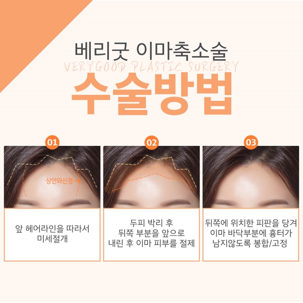 이마축소로 이상적인 이마높이로! 관련 이미지 5