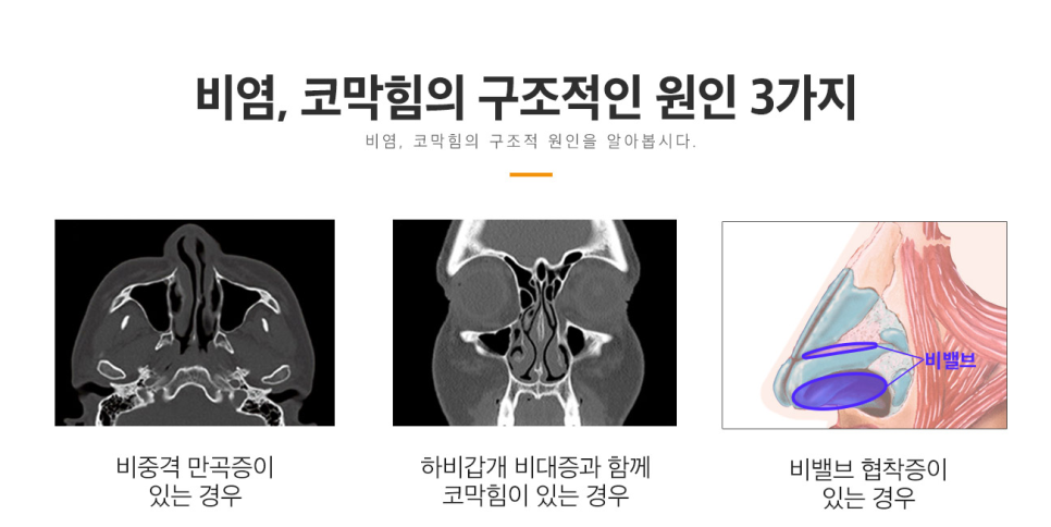 베리굿 비염코성형✨비염수술과 코성형을 동시에? 관련 이미지 3