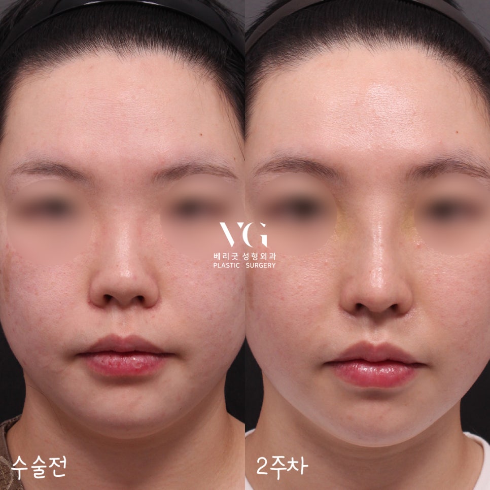 짧은 첫코성형도! 구축된 코재수술도! 베리굿성형외과✨ 관련 이미지 4
