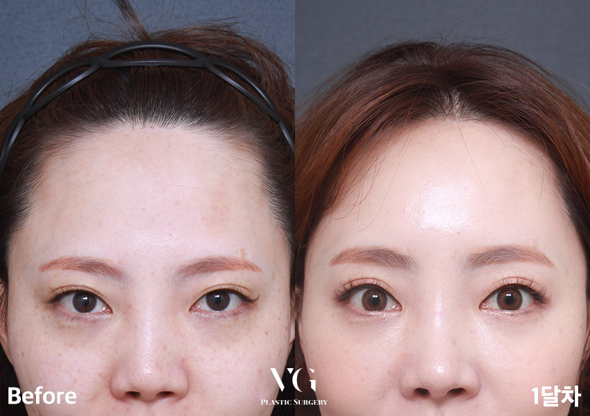 답답한 눈매? 무거운 눈? 베리굿 이마거상전후로 해결👀💖 관련 이미지 1