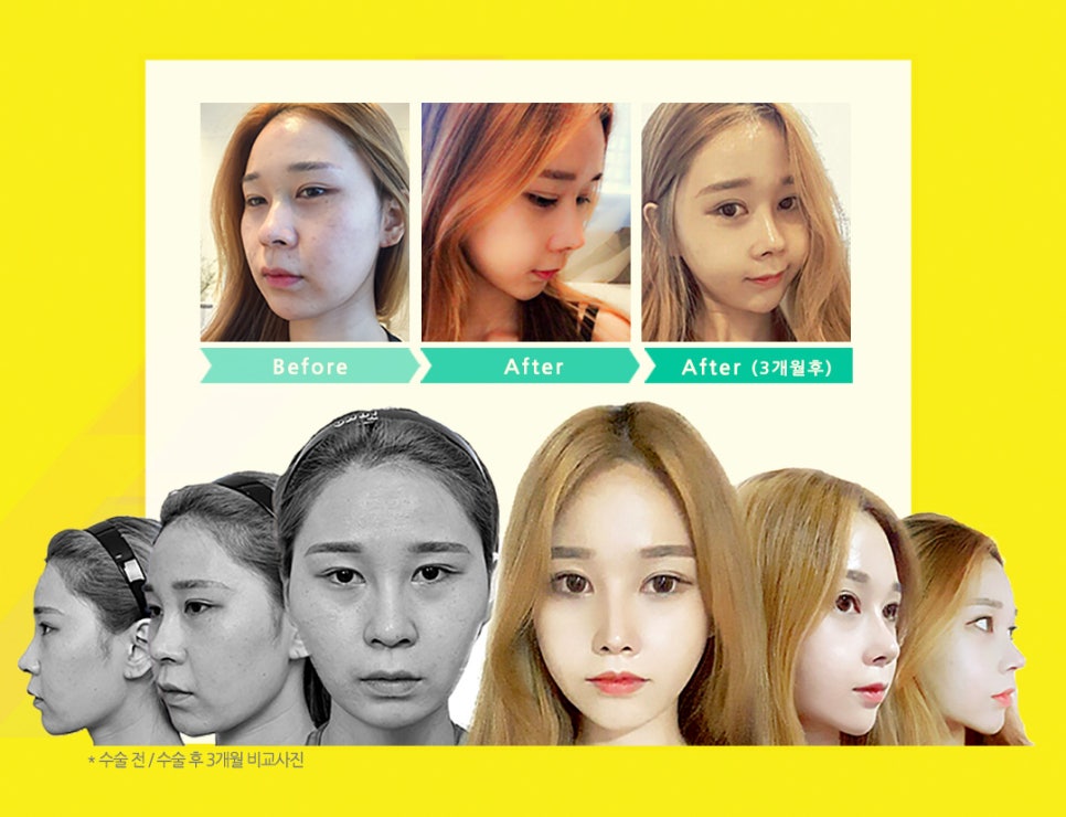 얼굴 작아지는법/ 베리굿성외과 3D광대축소술180만원 /강남역성형외과/강남역위치 관련 이미지 12